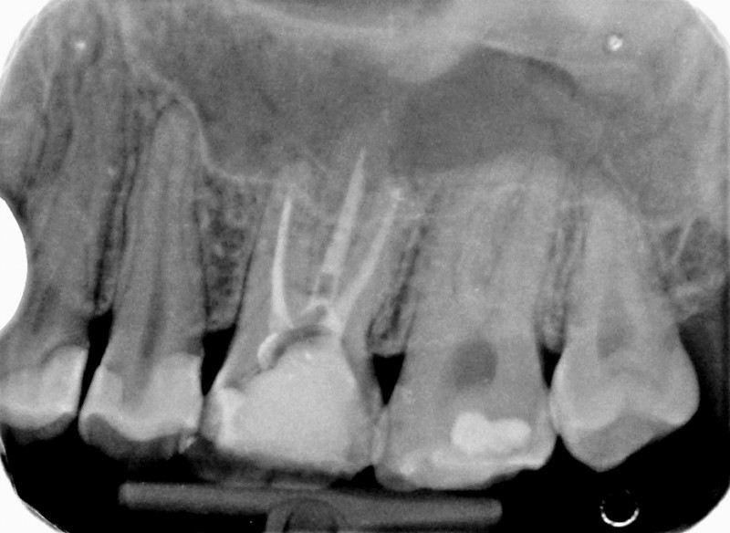 рентгенова снимка на зъб